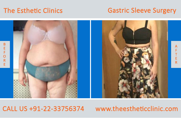 Gastric Sleeve Surgery, bariatric surgery before after photos in mumbai india (2)
